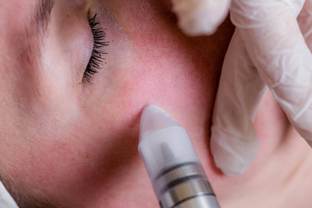 Mikrodermabrasion Hundertschön Kosmetik